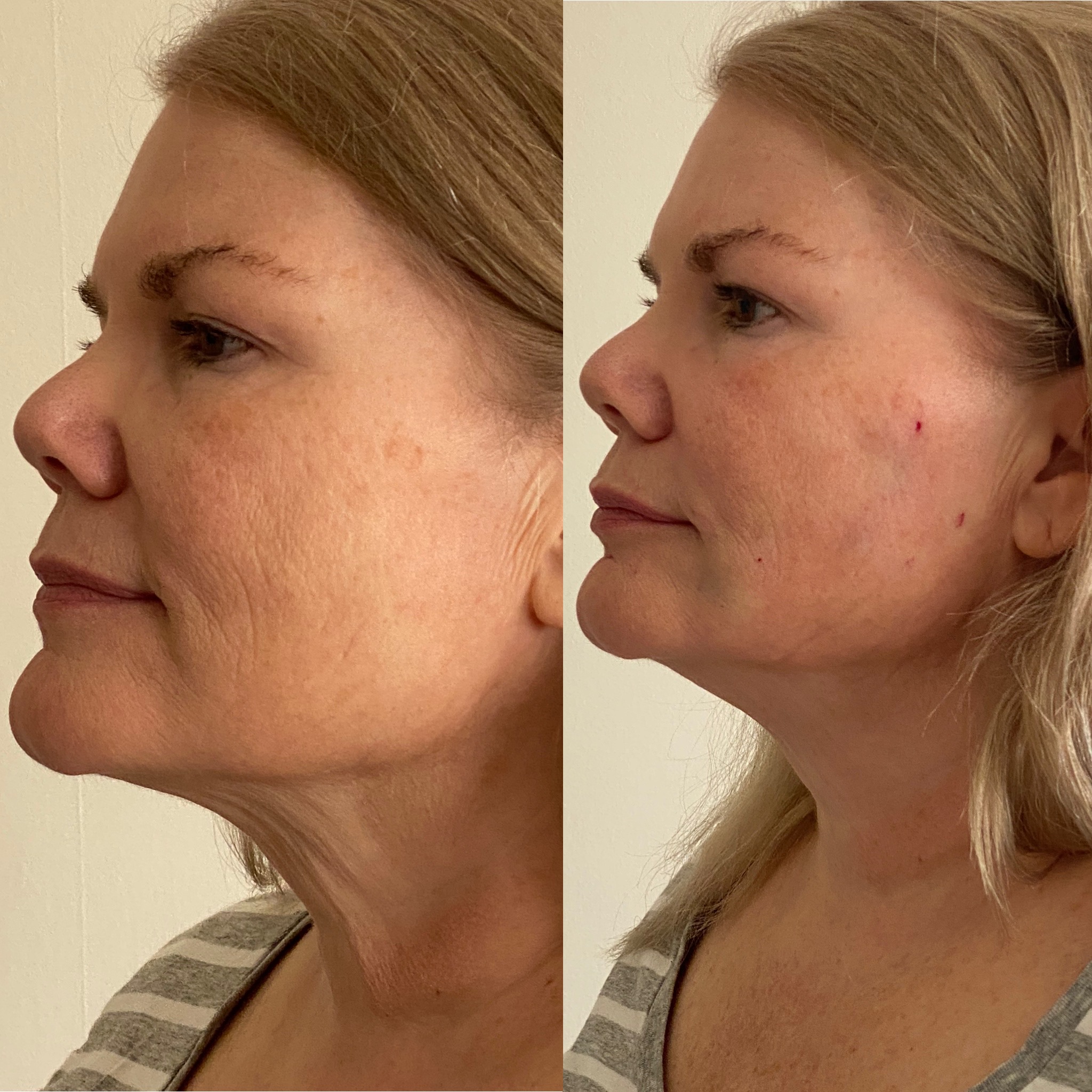 Before and after aesthetic treatment at Bleu Mirage aesthetics