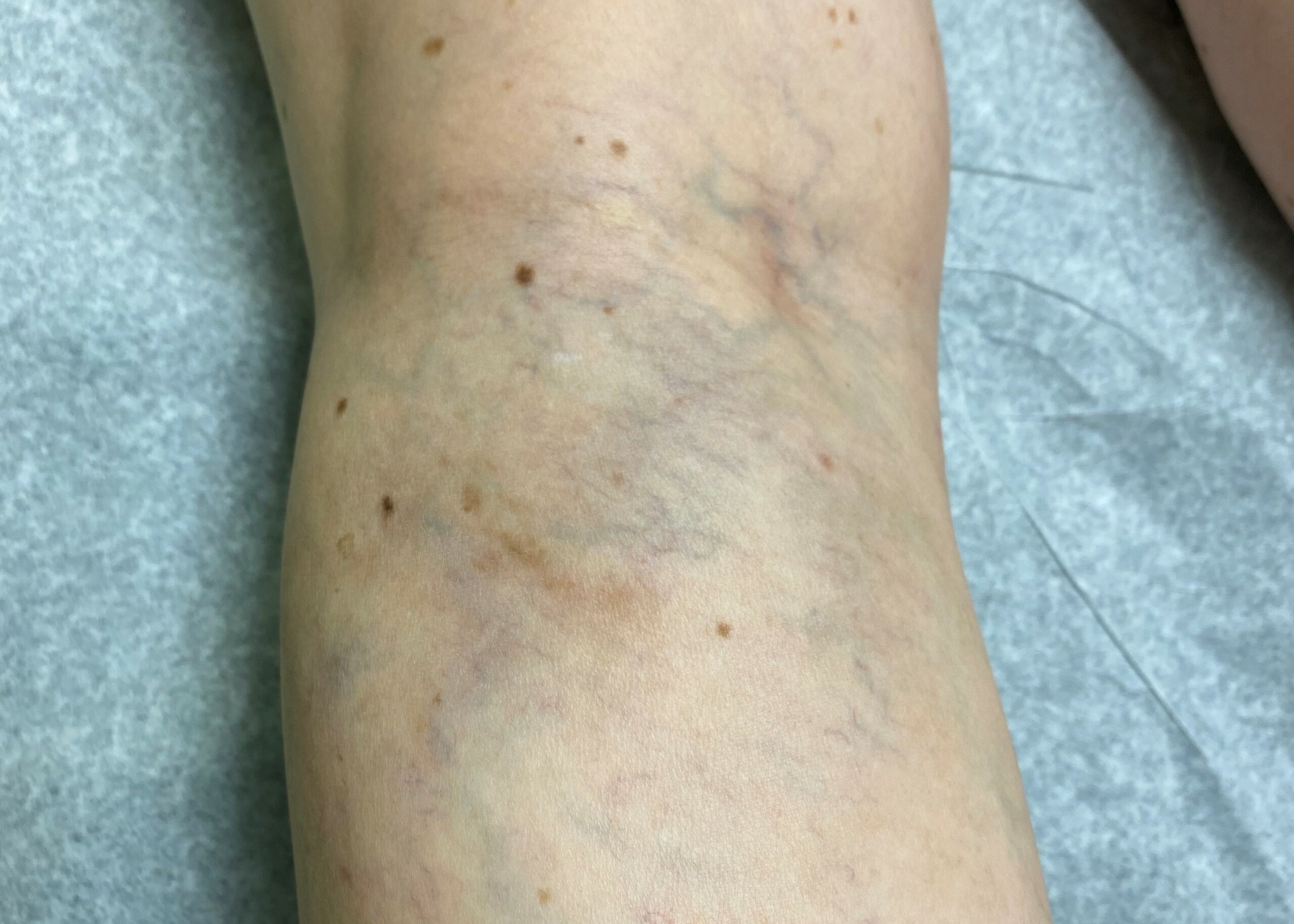 Before sclerotherapy therapy jpg file